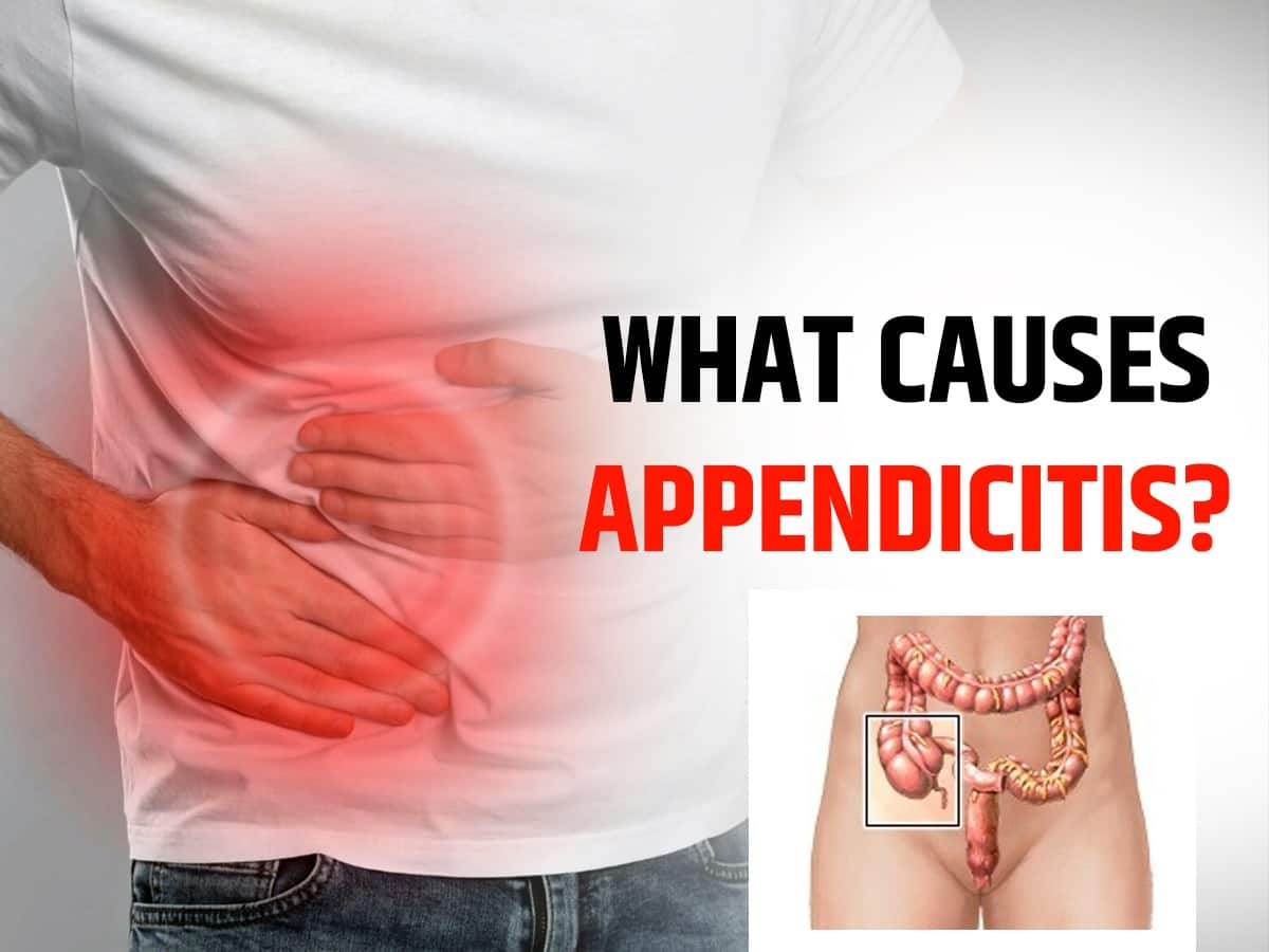 Appendicitis Can Cause Blockage In Blood Flow: 7 Causes of This Condition You Should Know